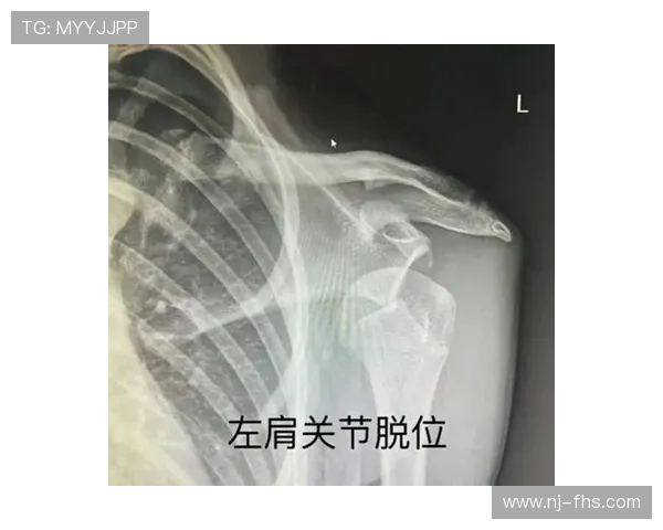 官方：奥尔莫左肩脱臼，或伤缺月余